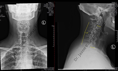 Cervical Kyphosis, Demystified