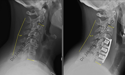 Cervical Kyphosis, Demystified