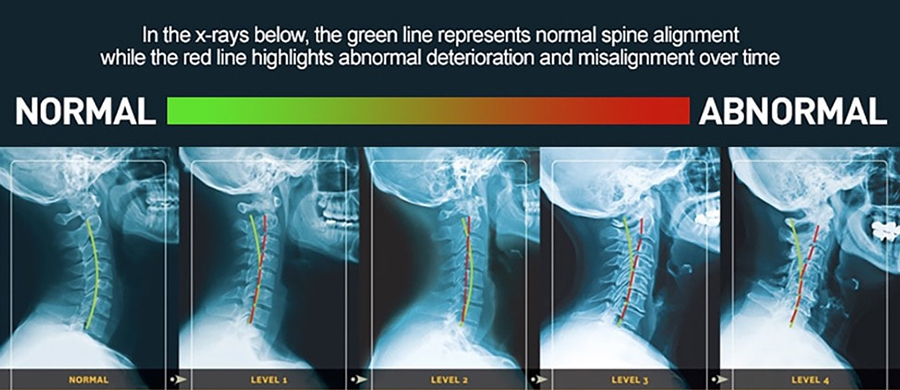 Cervical Kyphosis, Demystified