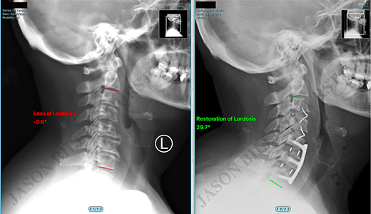 Cervical Spondylosis