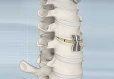 Anterior Cervical Discectomy with Fusion