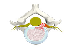 Cervical Herniated Disc