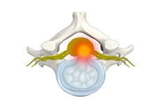 Cervical Disc Protrusion