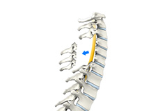 Posterior Cervical Laminectomy and Fusion