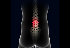 Complications of Spinal Surgery