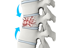 Spinal Compression Fractures