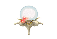 Lumbar Herniated Disc