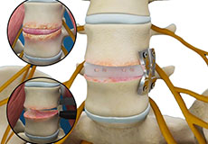 Lateral Lumbar Interbody Fusion