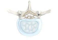 Lumbar Stenosis