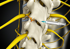 Lumbar Medial Branch Block