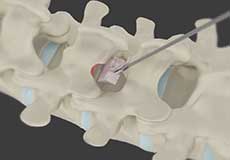 Minimally Invasive Lumbar Decompression