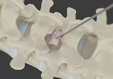 Minimally Invasive Lumbar Discectomy