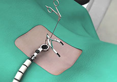 Minimally Invasive Spine Surgery for Spondylolisthesis