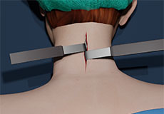 Neck Surgery