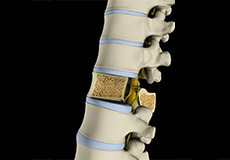 Osteoporosis of the Spine