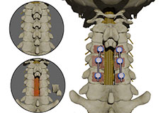 Posterior Cervical Decompression