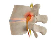 Spinal Stenosis