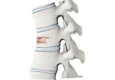 Vertebral Compression Fractures